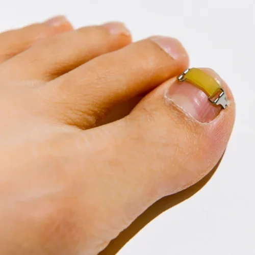 최고의 내성발톱 교정기 추천, 실제 후기 포함!